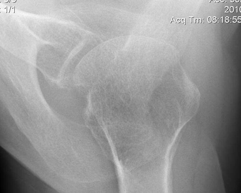 Shoulder Hill Sachs Axillary Lateral